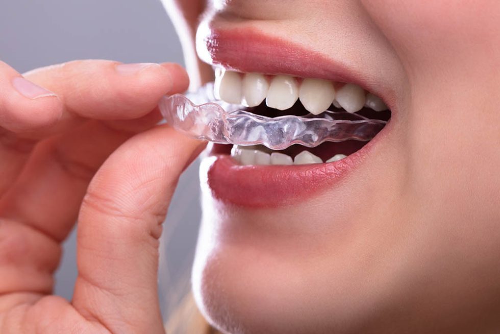 ClearCorrect Pinecrest | ClearCorrect Aligners Miami FL