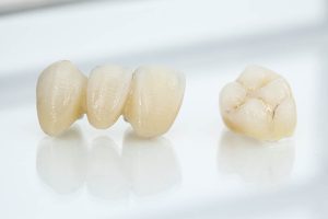 Porcelain Crowns