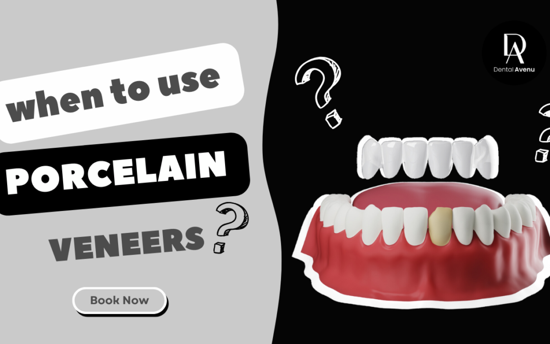 When To Use Porcelain Veneers in Miami, FL