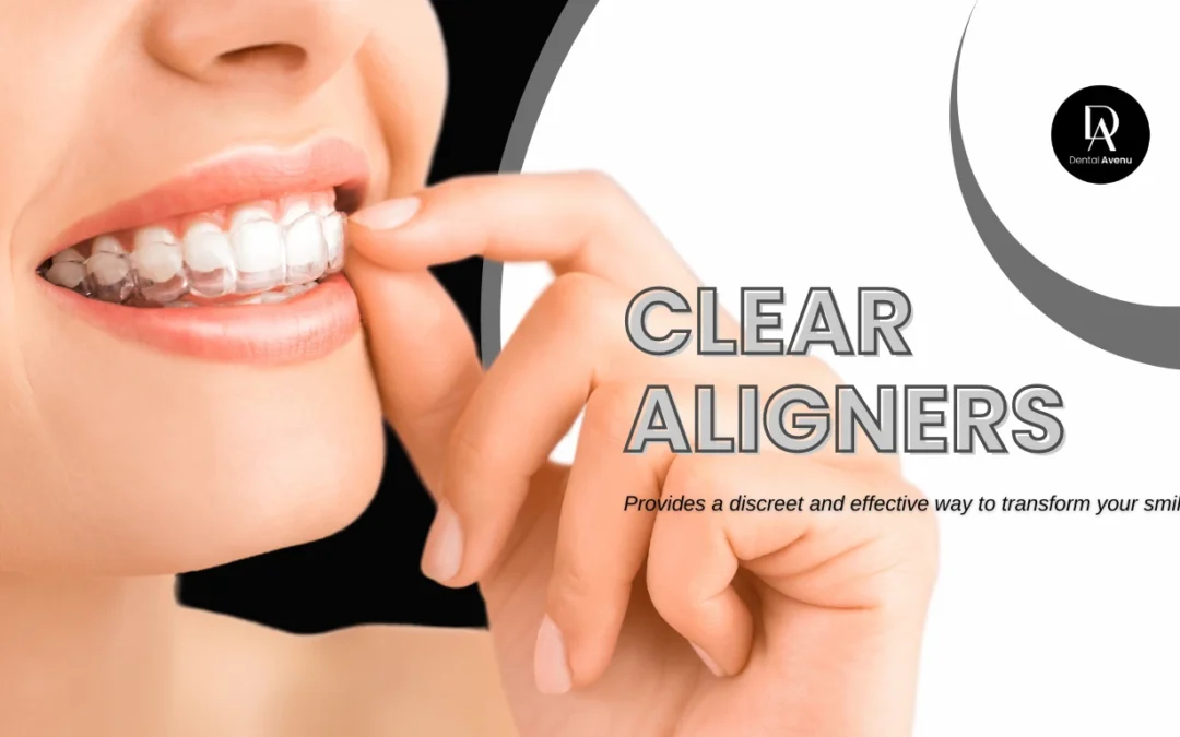 Clear Aligners  in Pinecrest, FL