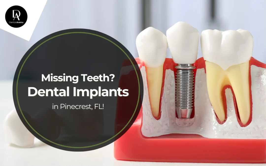 Missing Teeth? Dental Implants in Pinecrest, FL