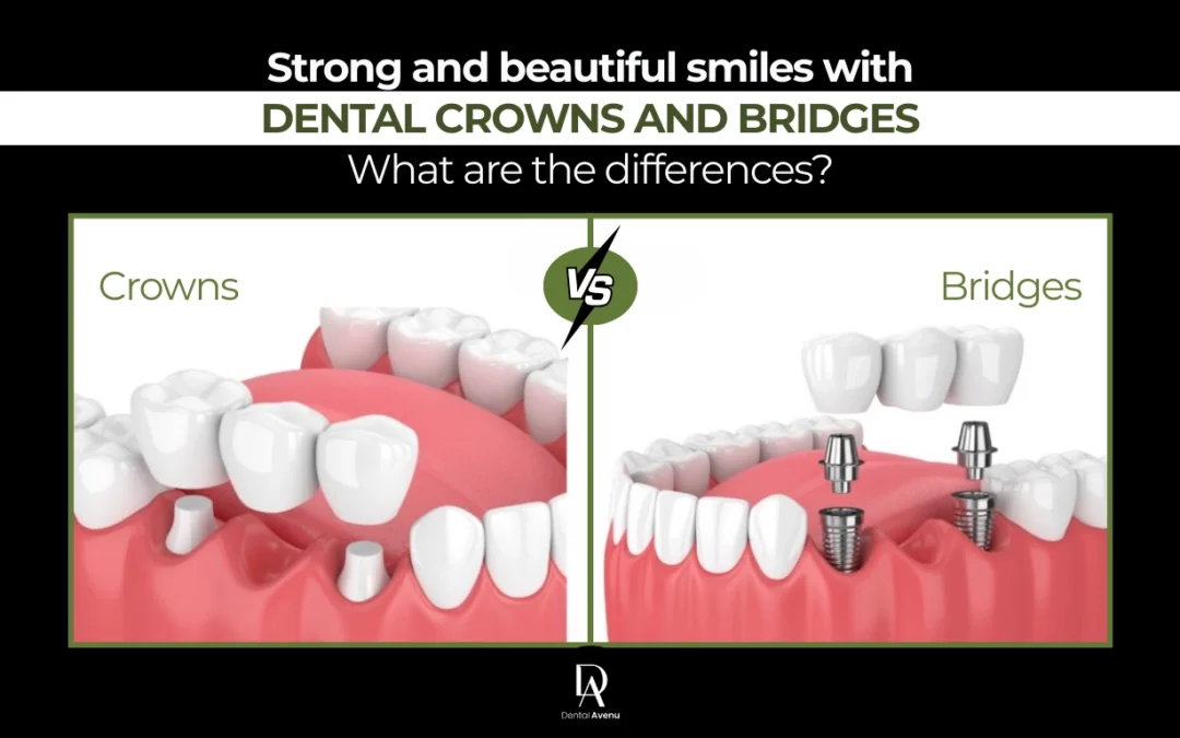 Complete Guide to Dental Crowns and Bridges in Pinecrest, FL